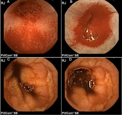 Prevención y tratamiento eficaz de úlceras estomacales