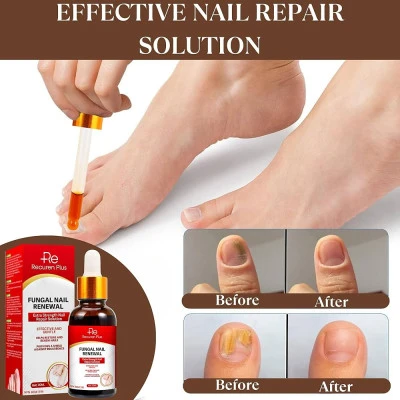 Prevención y tratamiento de infecciones por hongos en uñas