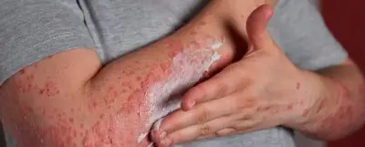 Prevenir y tratar infecciones por hongos en la piel