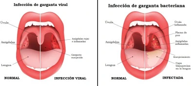 Prevenir y tratar infecciones de garganta de forma eficaz