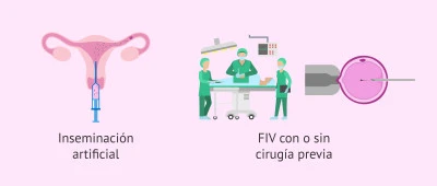 Beneficios de la terapia hormonal en endometriosis: manejo síntomas